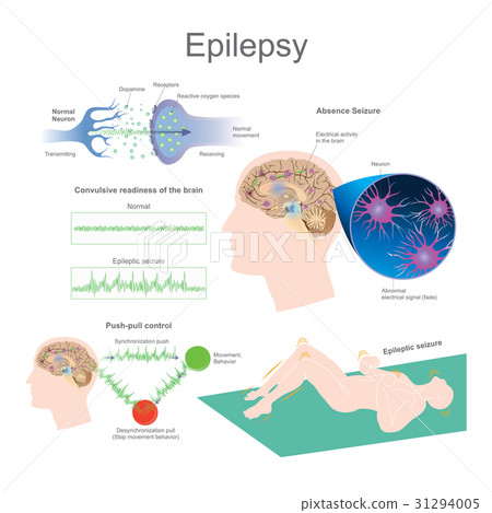 Epilepsy. 31294005