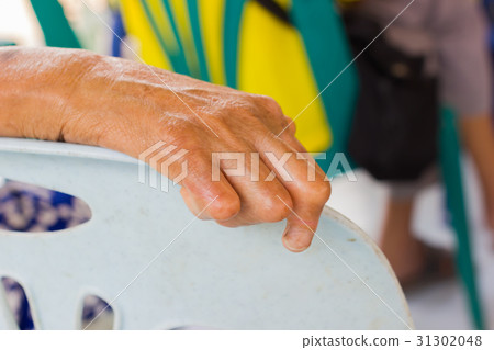 closeup hand of old asian woman leprosy closeup hand of old asian woman leprosy 31302048
