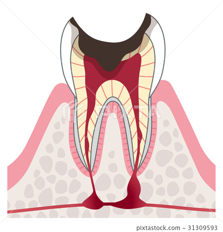 Advanced caries section view 31309593