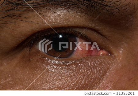 Eye disease Close close shot. Eye disease Close close shot. 31353201