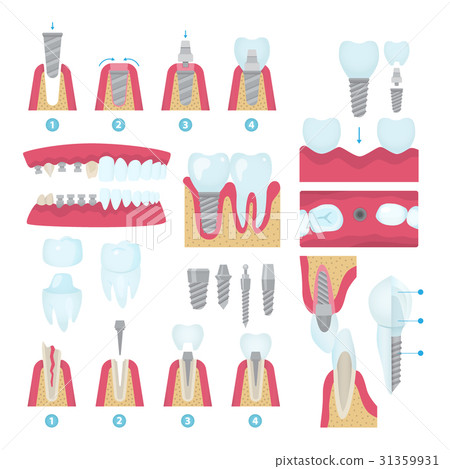 Dental crowns and implantation 31359931