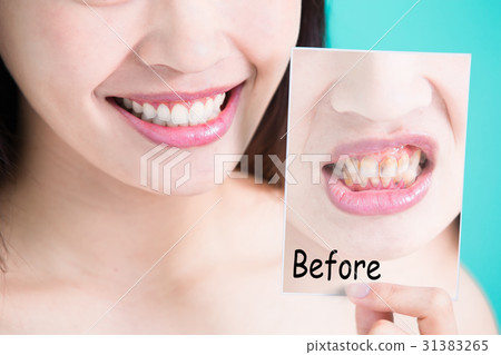 tooth whiten concept 31383265