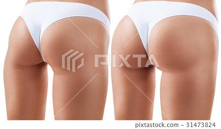 Female buttocks before and after treatment. Female buttocks before and after treatment. 31473824