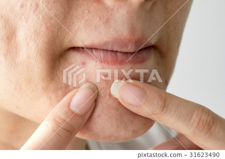 Acne pus, Close up photo of acne prone skin 31623490