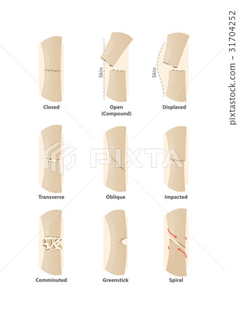 Type of fracture illustration vector on white. 31704252