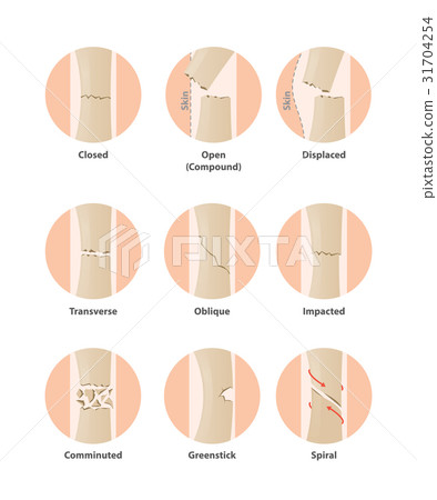 Type of fracture in circle illustration vector 31704254