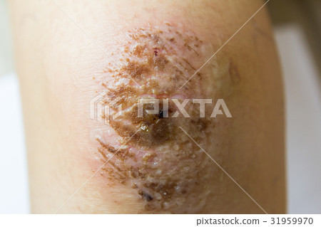 Closed up of red scab injury on woman knee Closed up of red scab injury on woman knee 31959970