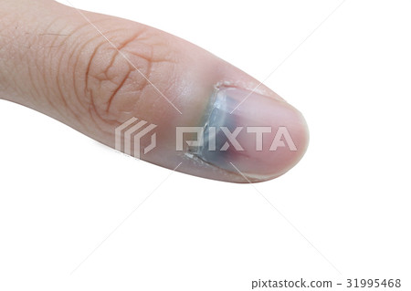 injured finger and bruised nail injured finger and bruised nail 31995468