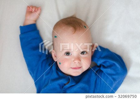 Baby with chickenpox on bed Baby with chickenpox on bed 32069750