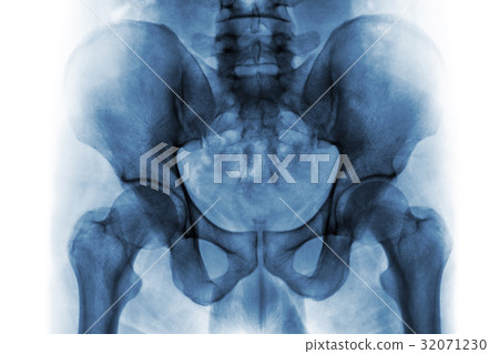 Film x-ray of normal human pelvis and hip joints . 32071230