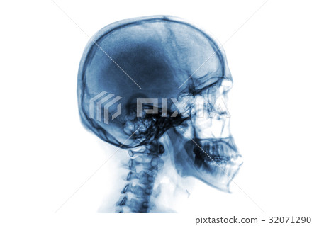 X-ray normal skull and cervical spine . 32071290