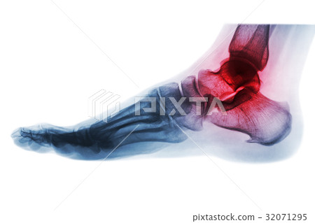 Arthritis of ankle . X-ray of foot . Lateral view Arthritis of ankle . X-ray of foot . Lateral view 32071295