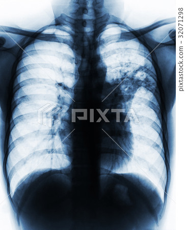 Pulmonary Tuberculosis .  32071298