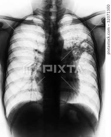Pulmonary Tuberculosis .  32071300