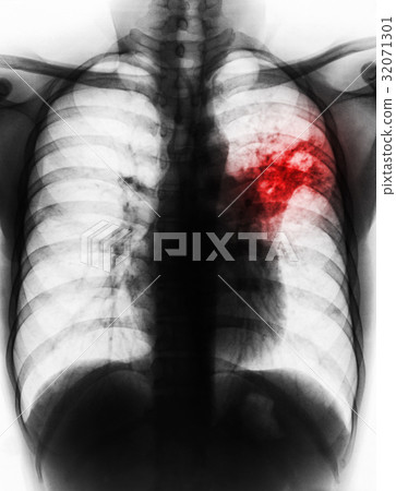 Pulmonary Tuberculosis . 32071301