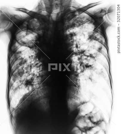 Pulmonary Tuberculosis .  32071304
