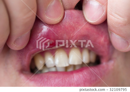Close-up of stomatitis into mouth 32109795