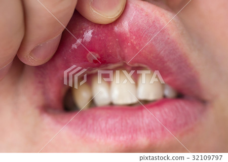 Close-up of stomatitis into mouth 32109797