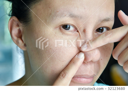 asian woman try to squeeze nose acne pimples 32123680