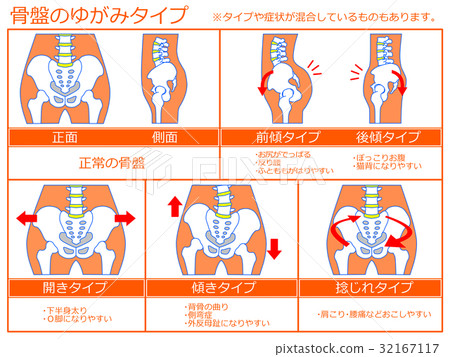 骨盆變形和分類圖4（橙色，有說明） 32167117