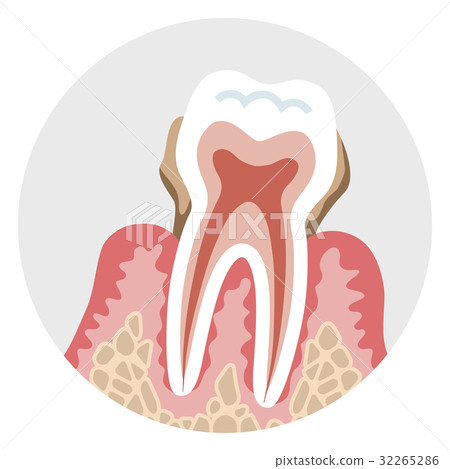 Sectional view of the late periodontal disease tooth 32265286
