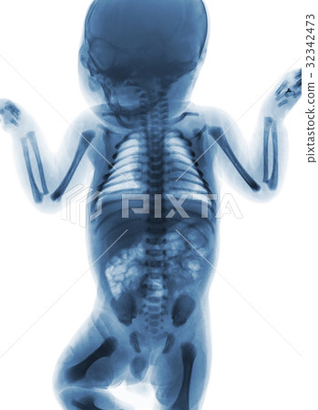 Film x-ray whole body of normal infant . Film x-ray whole body of normal infant . 32342473