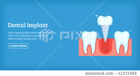 Dental implant banner horizontal, cartoon style 32372488