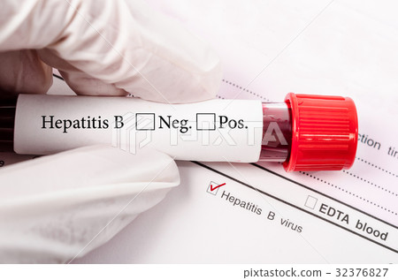 Hand holding Blood tube for hepatitis testing. 32376827