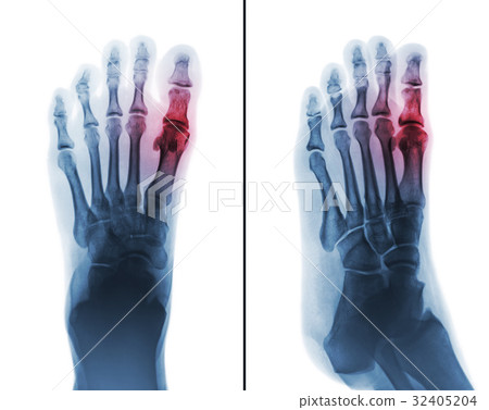 Gouty arthritis Gouty arthritis 32405204