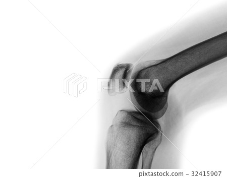 Film x-ray of normal knee joint 32415907