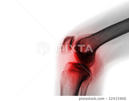 Film x-ray knee joint with arthritis Film x-ray knee joint with arthritis 32415908