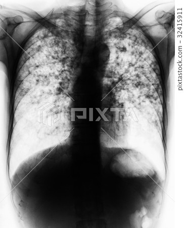 Pulmonary Tuberculosis . 32415911