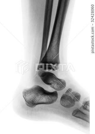 Film x-ray of normal child ankle . Lateral view Film x-ray of normal child ankle . Lateral view 32428060