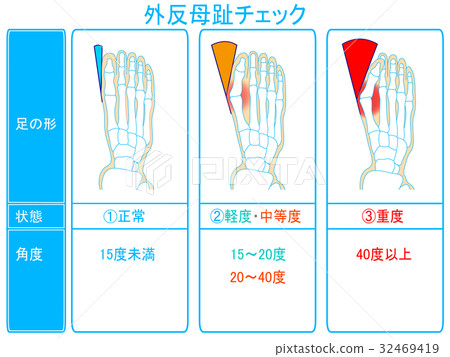 Progress degree check of hallux valgus (blue color, with explanation) 32469419