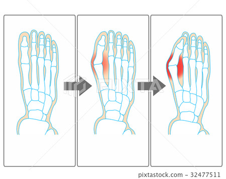 Image of deterioration of hallux valgus (gray) 32477511