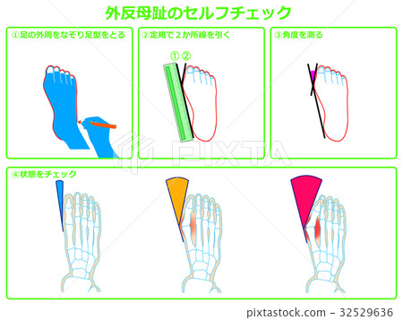 Hallux valgus self-check 1 (green, with description) Hallux valgus self-check 1 (green, with description) 32529636