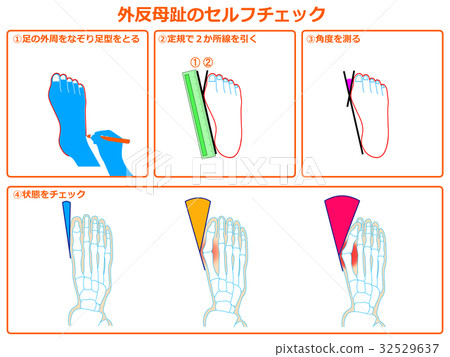 Hallux valgus self-check 1 (orange, with description) 32529637