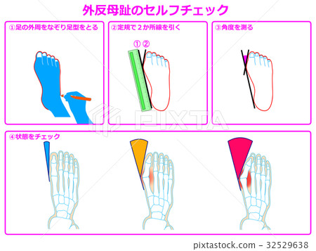 Hallux valgus self-check 1 (pink, with description) Hallux valgus self-check 1 (pink, with description) 32529638