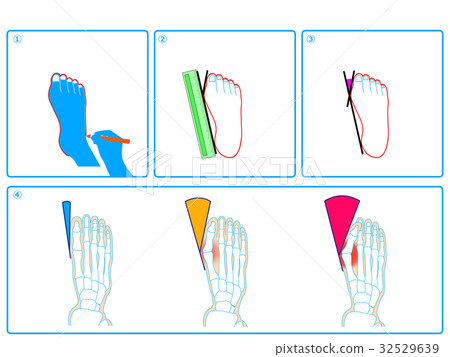 拇外翻自檢(藍色,無描述) 拇外翻自檢(藍色,無描述) 32529639