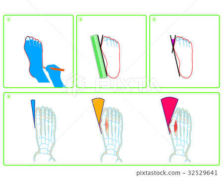 Hallux valgus self-check (green · no description) Hallux valgus self-check (green · no description) 32529641
