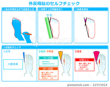 Self Check Of Hallux Valgus 2 Blue With Stock Illustration