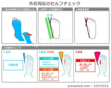 Self-check 2 of hallux valgus (gray · with explanation) Self-check 2 of hallux valgus (gray · with explanation) 32553919