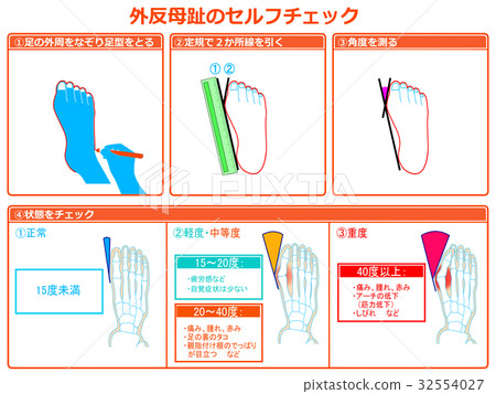 Self-check 2 of hallux valgus (with orange color and explanation) Self-check 2 of hallux valgus (with orange color and explanation) 32554027