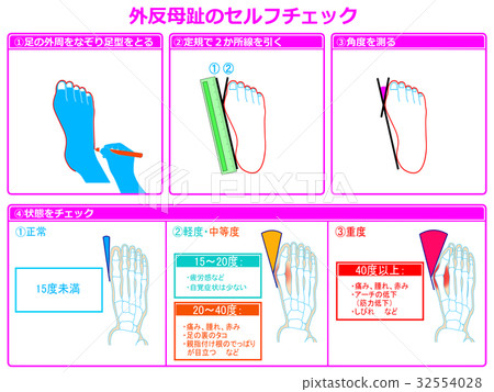 Self-check 2 of hallux valgus (with pink color and explanation) Self-check 2 of hallux valgus (with pink color and explanation) 32554028