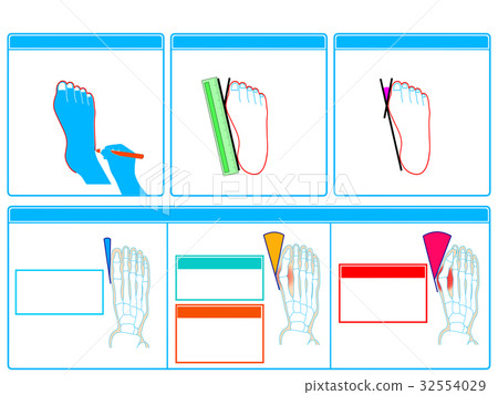 Self-check 2 of hallux valgus (blue, no explanation) Self-check 2 of hallux valgus (blue, no explanation) 32554029