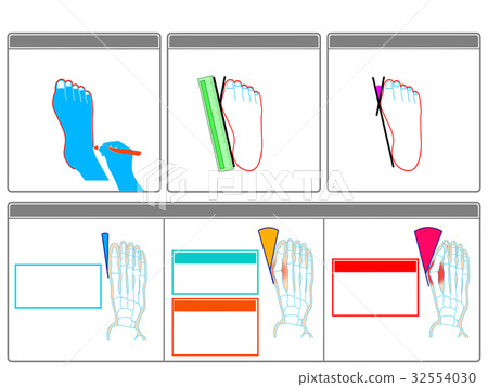 Self-check 2 of hallux valgus (gray · no explanation) 32554030