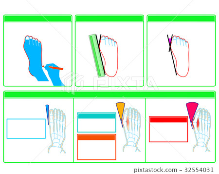 Self-check 2 of hallux valgus (green / no explanation) Self-check 2 of hallux valgus (green / no explanation) 32554031