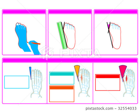 Self-check 2 of hallux valgus (pink color, no explanation) Self-check 2 of hallux valgus (pink color, no explanation) 32554033