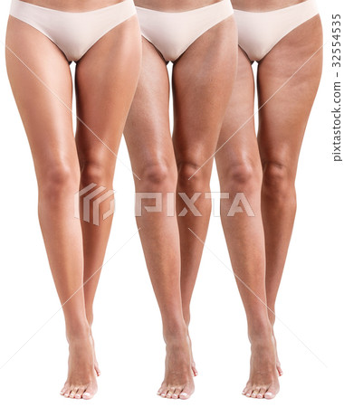 Woman legs before and after treatment. 32554535