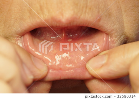 Close-up of stomatitis into mouth Close-up of stomatitis into mouth 32580314